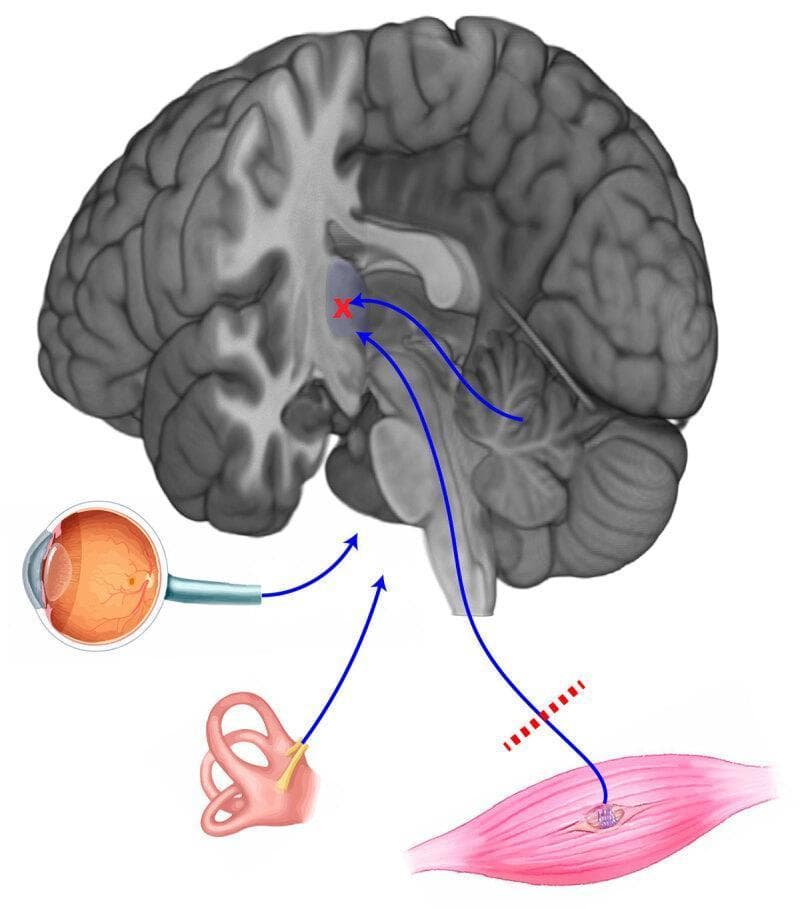 This pathophysiology diagram illustrates the integration of sensory inputs required for balance and postural control. The central feature is a sagittal section of the human brain, highlighting the cerebellum, brainstem, and cerebral cortex. Three primary peripheral systems are shown providing input to the central nervous system: the visual system (represented by a cross-section of the eye), the vestibular system (represented by the inner ear and semicircular canals), and the proprioceptive system (represented by a skeletal muscle with a muscle spindle). Blue arrows trace the afferent pathways from these organs toward a central integration area in the brain. A red 'X' and dashed red lines over the proprioceptive pathway from the muscle indicate a site of dysfunction or sensory interruption. The diagram serves as an educational tool to demonstrate how multisensory integration—combining visual, vestibular, and proprioceptive data—is essential for maintaining equilibrium, and how disruptions in these pathways contribute to clinical balance disorders.