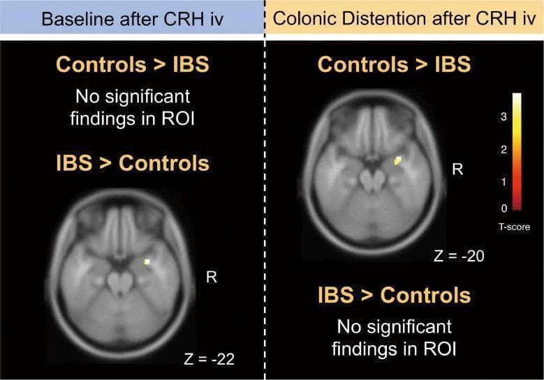 This diagnostic image displays axial slices of functional MRI (fMRI) scans comparing brain activity between Irritable Bowel Syndrome (IBS) patients and healthy controls following intravenous Corticotropin-Releasing Hormone (CRH) injection. The left panel shows 'Baseline after CRH iv' at axial section Z = -22, where IBS patients demonstrate significantly greater activation in the right amygdala compared to controls. The right panel shows 'Colonic Distention after CRH iv' at axial section Z = -20, where healthy controls exhibit significantly higher activation in the right amygdala than IBS patients. Significant findings are indicated by yellow voxel clusters overlaid on a single-subject MRI template. A T-score scale (0 to 3) is provided on the right, with yellow representing higher statistical significance. Regions of Interest (ROI) analysis was conducted with a threshold of PFWE-corrected < 0.05. This image illustrates the differential neural processing of visceral stress and baseline states in the brain-gut axis, specifically highlighting the amygdala's role in the pathophysiology of IBS.