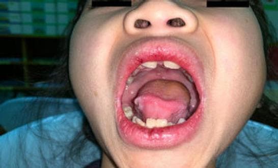 This clinical photograph shows a close-up intraoral view of a pediatric patient's oral cavity and perioral region. The image demonstrates mucocutaneous manifestations typical of systemic inflammatory or autoimmune conditions. Key visible findings include multiple shallow, erythematous ulcers with ill-defined borders located on the dorsal and lateral surfaces of the tongue and the hard palate. The lips (cheilitis) appear significantly erythematous and edematous, with evidence of crusting and irregularity along the vermillion border of the upper and lower lips. The oral mucosa shows generalized hyperemia. In the clinical context of malar rash and systemic symptoms, these findings are highly suggestive of systemic lupus erythematosus (SLE) mucosal involvement. The image serves as an educational resource for identifying painless oral ulcerations and inflammatory lip changes as diagnostic criteria in pediatric rheumatology.
