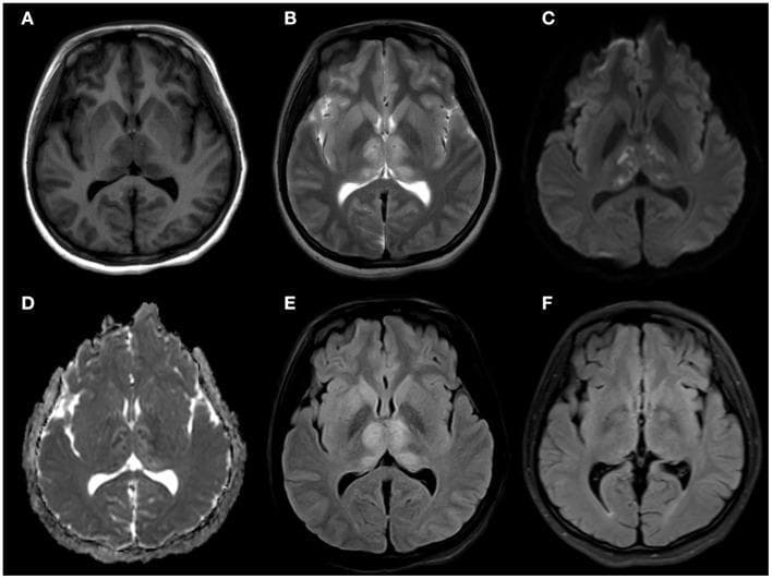 This composite diagnostic image displays six axial brain MRI sequences (A-F) documenting a case of viral encephalitis, specifically Japanese Encephalitis. Panels A-E represent the acute phase, showing symmetric involvement of the deep gray matter structures. (A) T1-weighted image reveals subtle hypointensity in the bilateral thalami, head of the caudate nuclei, and right lenticular nucleus. (B) T2-weighted imaging demonstrates corresponding hyperintensity in these regions, including the hippocampi. (C) Diffusion-weighted imaging (DWI) and (D) Apparent Diffusion Coefficient (ADC) map show bilateral punctate hyperintensity on DWI with corresponding hypointensity on ADC, indicating restricted diffusion and cytotoxic edema. (E) T2-FLAIR imaging confirms hyperintensity in the bilateral thalami and caudate heads without mass effect. (F) A follow-up T2-FLAIR image from two months later shows complete resolution of the previously seen signal abnormalities. The symmetrical involvement of the thalami and basal ganglia is a hallmark radiological finding for Flavivirus infections. This sequence serves as an educational example of deep gray matter restricted diffusion and its longitudinal progression in neuro-infectious diseases.