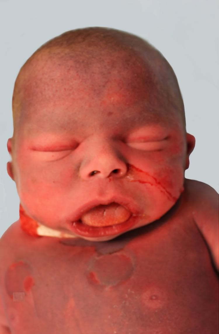 This clinical photograph displays the facial and upper torso characteristics of a neonate with Williams Syndrome (7q11.23 deletion). The image illustrates classic 'elfin' facies, including periorbital puffiness (soft tissue fullness around the eyes), a short nose with a depressed nasal bridge and anteverted nares, and midface fullness. The mouth is wide with thick, prominent lips and a slightly protruding, hypertrophied tongue. Additional findings include macrocephaly and a shortened neck. The skin exhibits a generalized reddish-purple hue, likely post-mortem or related to systemic congestion, with visible circular lesions on the upper chest. Clinical context suggests these features are associated with multisystemic manifestations such as supravalvular aortic stenosis. The photograph serves as an educational resource for identifying dysmorphic features in genetic syndromes and neonatal pathology.