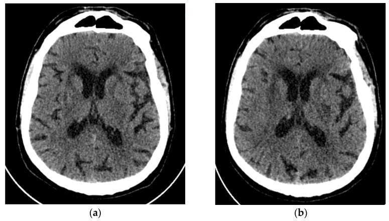 Two side-by-side axial non-contrast brain CT scans demonstrating the progression of an acute ischemic stroke. Scan (a), obtained at the time of emergency admission, shows baseline chronic changes including ischemic microangiopathy represented by mild periventricular hypodensity. No evidence of acute intracranial hemorrhage or definitive acute infarction is visible at this initial stage. Scan (b), a follow-up performed 48 hours later on the same patient, reveals the evolution of a focal hypodense lesion in the left basal ganglia region. The location of this infarct corresponds specifically to the neuroanatomical distribution of the left anterior choroidal artery (AChA), involving the posterior limb of the internal capsule. Both scans show similar ventricular morphology and cortical sulcal patterns, without significant mass effect or midline shift. This comparison serves as an educational example of how acute ischemic lesions may only become clearly visible on CT imaging after a period of temporal evolution, highlighting the importance of clinical correlation and follow-up imaging in suspected stroke cases.