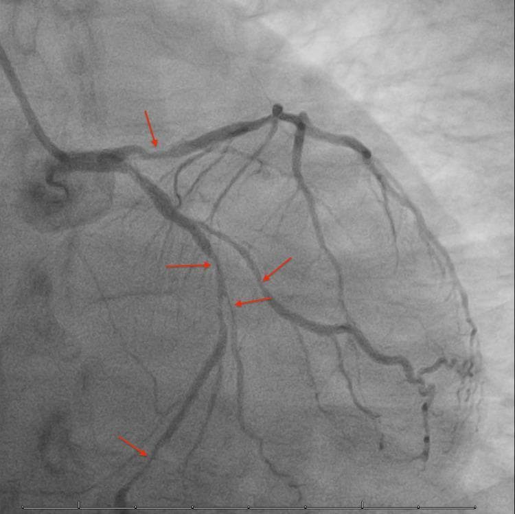 This diagnostic image is a coronary angiogram (left heart catheterization) showing the left coronary artery system. The visual focus is on the Left Anterior Descending (LAD) artery and the Left Circumflex (LCx) artery along with their diagonal and marginal branches. Multiple red arrows indicate areas of multifocal pathology, characterized by significant luminal narrowing and abrupt terminations of contrast opacification. Specifically, the image demonstrates diffuse atherosclerosis with severe segmentary stenoses (ranging from 60% to 90% in clinical context) and distal vessel occlusions. These findings are consistent with severe multivessel coronary artery disease (CAD), manifesting as compromised distal blood flow and reduced vessel diameter in both the LAD and LCx territories. This imaging is typically used in cardiology to evaluate ischemic heart disease and plan revascularization strategies.