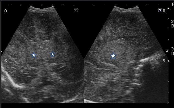This diagnostic image displays side-by-side coronal (left) and sagittal (right) cranial ultrasound views of a neonate. The imaging shows findings characteristic of severe hypoxic-ischemic encephalopathy (HIE), specifically Sarnat stage III. Both views demonstrate diffuse, markedly increased echogenicity involving the cerebral cortex and deep gray matter structures. Specifically, white stars mark the bilateral thalamic and basal ganglia regions, which appear hyperechoic compared to normal neonatal brain tissue. Significant cerebral edema is present, resulting in a loss of normal anatomical definition and the compression of the lateral ventricles, which are slit-like or barely visible. These visual markers indicate profound global ischemic injury and are critical for the bedside evaluation of neurodevelopmental prognosis in neonatal intensive care. The image serves as a teaching tool for recognizing sonographic patterns of acute perinatal asphyxia and diffuse brain swelling.