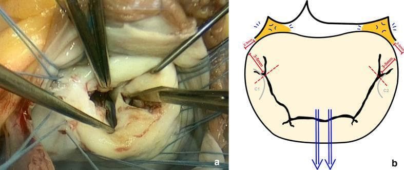 This figure presents a dual-panel comparison of a mitral valve commissurotomy procedure for rheumatic heart disease. Panel (a) is an intraoperative clinical photograph showing the surgical field through an atriotomy. The mitral valve leaflets are visible, appearing thickened and pale, consistent with rheumatic changes. Surgical instruments, including nerve hooks and forceps, are actively manipulating the anterior and posterior leaflets, while traction sutures are placed along the valve annulus to provide exposure. Panel (b) is a schematic illustration defining the surgical protocol for the commissurotomy. It highlights the trigones in orange and uses blue arrows to indicate the symmetrical traction applied by nerve hooks around the major chordae. Grey outlines identify the commissural leaflets (C1 and C2). Red dashed lines and bars quantify the safety margins for the incision, specifically stopping 3 to 5 mm from the annulus and 2 to 3 mm laterally from the trigones to preserve subvalvular structures and chordal integrity. The visual serves to bridge clinical practice with the precise anatomical landmarks required for successful valve repair.