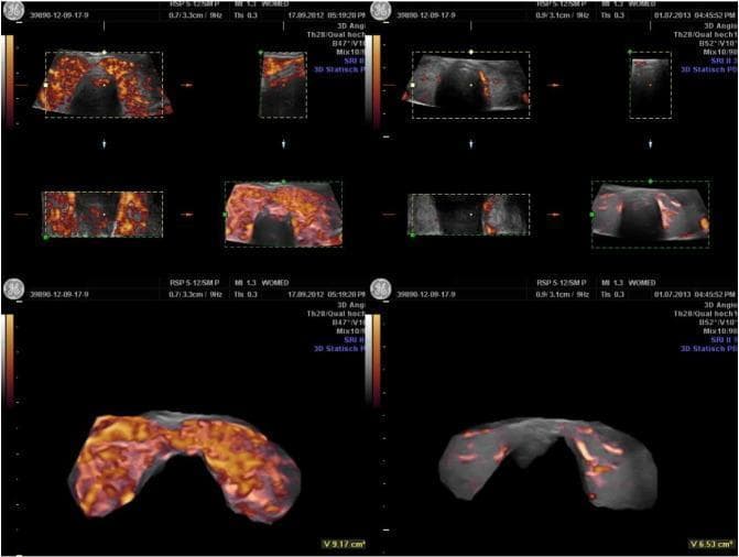 This diagnostic image set features comparative ultrasound studies of the thyroid gland in a patient with hyperthyroidism, demonstrating changes in morphology and perfusion over a 14-month treatment interval. The left panel shows the initial state with 3D Power Doppler imaging revealing marked hypervascularity (thyroid inferno) across both lobes and the isthmus, with a total glandular volume of 9.17 cm³. The right panel shows the follow-up state, characterized by a significant reduction in vascular density and a decrease in glandular volume to 6.53 cm³. The upper sections include multiplanar 2D ultrasound views (transverse and sagittal) with Power Doppler overlays, while the lower sections provide 3D volumetric reconstructions. These images illustrate the clinical utility of Power Doppler in assessing parenchymal vascularization intensity (Vascularization Index) and monitoring the response to therapy in autoimmune or endocrine thyroid disorders. The visual evidence correlates the reduction of thickened intra-thyroidal vessels and overall flow with the normalization of thyroid function.
