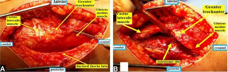 Two intraoperative clinical photographs (A and B) demonstrating a modified Ganz surgical hip dislocation approach. Image A shows a straight lateral skin incision with superficial dissection, exposing the underlying musculoskeletal anatomy. Key structures are labeled, including the incised fascia lata, the vastus lateralis muscle (caudal-anterior), the greater trochanter (cranial-anterior), and the gluteus medius muscle (cranial). Image B depicts the subsequent greater trochanteric osteotomy. An oscillating saw has been used to create a bone cut, labeled as the osteotomy site, located posterior to the vastus lateralis ridge. This procedure allows for the mobilization of the greater trochanter with its attached gluteus medius to preserve the blood supply to the femoral head. Both images include anatomical orientation markers (anterior, posterior, cranial, and caudal) to clarify the surgical perspective. This visual material is intended for orthopedic education, specifically regarding surgical techniques for treating slipped capital femoral epiphysis (SCFE) or other hip-preserving surgeries.