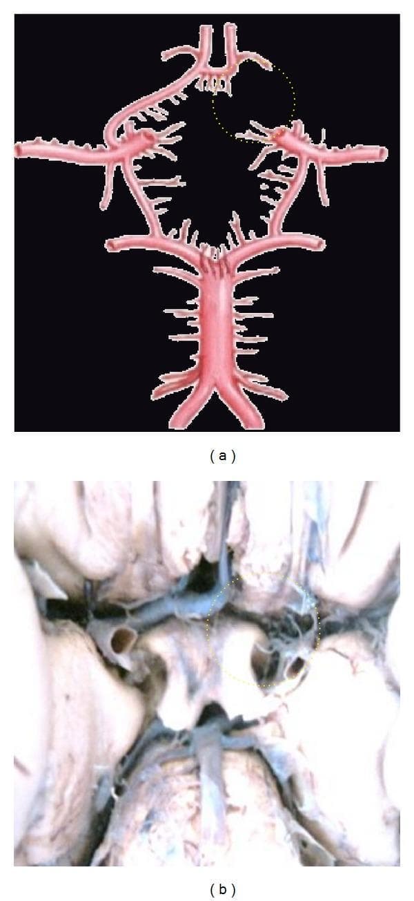 This medical visual content consists of an anatomical diagram (a) and a corresponding clinical photograph of a cadaveric dissection (b) illustrating neurovascular anatomy. The focus is on the Circle of Willis, specifically demonstrating a congenital vascular variation known as aplasia of the A1 segment of the anterior cerebral artery (ACA). In both panels, a yellow dotted circle highlights the area where the right A1 segment should connect the internal carotid artery to the anterior communicating artery (ACoA). The absence of this segment results in an incomplete Circle of Willis, which has clinical significance for collateral cerebral blood flow. The diagram (a) clearly depicts the major components of the cerebral arterial circle, including the basilar artery, posterior cerebral arteries, internal carotid arteries, and the intact left A1 and A2 segments. The clinical photograph (b) provides a real-world view of the same anatomical deficiency at the base of the brain. This material is designed for advanced medical education in neuroanatomy and radiology, emphasizing common vascular anomalies.