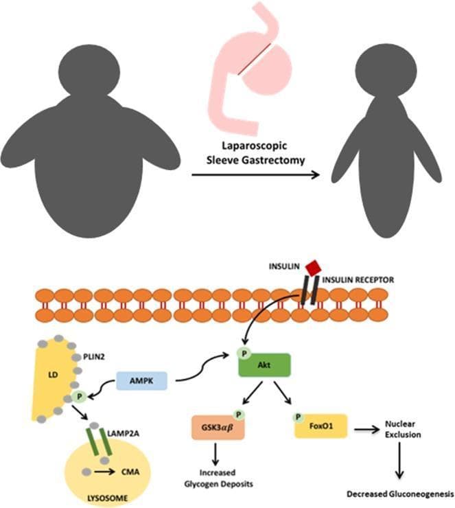 This pathophysiology diagram illustrates the proposed metabolic mechanisms underlying the reversal of Non-Alcoholic Fatty Liver Disease (NAFLD) and insulin resistance following Laparoscopic Sleeve Gastrectomy (SG). The upper section shows a clinical progression from an obese silhouette to a post-surgical weight-loss state. The lower section details cellular signaling pathways in a hepatocyte. Key features include: 1) Insulin receptor activation leading to Akt phosphorylation. 2) Downstream signaling where activated Akt phosphorylates GSK3αβ, resulting in increased glycogen deposits, and FoxO1, leading to nuclear exclusion and decreased gluconeogenesis. 3) An AMPK-mediated pathway where AMPK phosphorylates PLIN2 on lipid droplets (LD). This phosphorylation facilitates PLIN2 binding to LAMP2A, initiating Chaperone-Mediated Autophagy (CMA) within a lysosome. This mechanism demonstrates how reduced caloric intake post-SG enhances lipid catabolism and improves insulin sensitivity. The diagram is a high-level educational resource for endocrinology and gastroenterology, focusing on the interplay between bariatric surgery, AMPK activation, and hepatic metabolic regulation.
