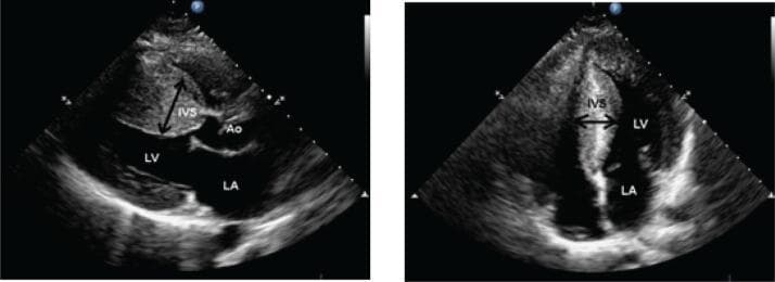 Transthoracic echocardiogram (TTE) images displaying classic hallmarks of Hypertrophic Cardiomyopathy (HCM). The left panel shows a parasternal long-axis view, while the right panel shows an apical four-chamber view. Both views demonstrate severe asymmetrical hypertrophy of the interventricular septum (IVS), highlighted by calipers. The IVS is markedly thickened compared to the posterior wall, exhibiting increased echogenicity that may suggest myofibrillar disarray or fibrosis. This septal hypertrophy results in significant encroachment into the left ventricular (LV) cavity, leading to a reduced LV chamber size. The left atrium (LA) appears dilated, a common secondary finding due to diastolic dysfunction. In the long-axis view, the thickened septum is positioned near the aortic root (AO), illustrating the anatomical substrate for potential left ventricular outflow tract (LVOT) obstruction. These findings are critical for diagnosing obstructive or non-obstructive HCM and assessing the risk of cardiovascular complications.