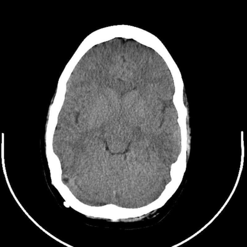 An axial non-contrast computed tomography (CT) scan of the head demonstrating features consistent with slit-ventricle syndrome in the context of chronic ventriculoperitoneal shunting. The primary finding is the presence of slit-like lateral ventricles, which appear remarkably small and narrow centrally within the brain parenchyma. The brain tissue shows a mottled gray attenuation and appears tightly compacted against the inner table of the cranial vault, with significantly effaced cortical sulci and minimal visible extracerebral cerebrospinal fluid (CSF) spaces. The cranial vault is represented by a thick, hyperdense (bright white) bony circumference. A small, focal hyperdensity is noted along the right inner table of the skull, potentially representing a shunt component or calcification. This diagnostic image illustrates the loss of intracranial compliance and ventricular collapse often seen in patients with long-standing CSF diversion, providing educational value for neurosurgery and neuroradiology training.