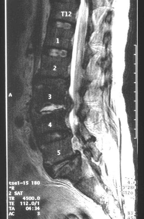 This sagittal T2-weighted magnetic resonance imaging (MRI) scan of the lumbar spine demonstrates clinical findings diagnostic of infectious spondylodiscitis at the L3/L4 level. The image shows significant disruption of the intervertebral disc space between L3 and L4, characterized by increased signal intensity and loss of normal disc morphology. Adjacent vertebral bodies (L3 and L4) exhibit signal alterations at the endplates, consistent with osteomyelitis. A prominent finding is the presence of an epidural abscess, visible as a hyperintense collection within the spinal canal at the L3/L4 level, causing potential compression of the thecal sac. Furthermore, there is evidence of extensive inflammatory changes in the surrounding soft tissues, including the paravertebral regions and psoas muscles. In contrast, the superior segments (T12 through L2) and the inferior L5 segment maintain relatively normal vertebral height, alignment, and signal characteristics. This educational image illustrates the classic imaging triad of discitis, osteomyelitis, and associated abscess formation in the setting of spinal infection.