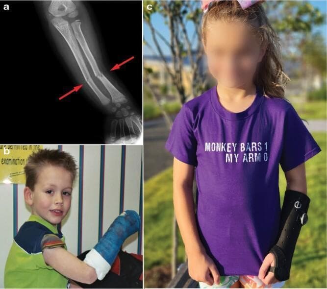 This composite educational resource illustrates pediatric forearm fractures and subsequent immobilization methods. (a) A diagnostic X-ray of a child's forearm shows midshaft (diaphyseal) fractures of both the radius and ulna. Red arrows highlight the specific sites: the radius exhibits a complete angular fracture with disruption of both cortices, while the ulna demonstrates an incomplete greenstick fracture, characterized by cortical buckling and bending without full separation. (b) A clinical photograph shows a young child with a traditional hard fiberglass cast extending from the distal humerus to the metacarpals, providing rigid immobilization of the elbow and wrist. (c) A contemporary clinical photograph depicts a child wearing a modern soft splint, a removable orthotic device that provides support while allowing greater comfort and limited movement compared to a rigid cast. The material emphasizes pediatric resilience and the evolution of orthopedic management for common childhood injuries like those sustained from falls onto an outstretched hand (FOOSH).
