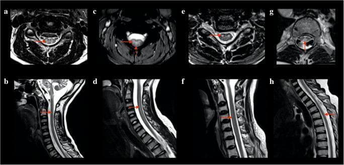 This diagnostic imaging composite displays eight T2-weighted magnetic resonance imaging (MRI) scans of the spinal cord in patients with Kearns-Sayre syndrome (KSS). The images consist of paired axial (a, c, e, g) and sagittal (b, d, f, h) views demonstrating four distinct patterns of intramedullary T2-hyperintense lesions. Panels (a) and (b) illustrate the 'H' pattern, where hyperintensity is localized to the central gray matter. Panels (c) and (d) show the 'H plus' pattern, involving both the gray matter and the posterior white matter columns. Panels (e) and (f) demonstrate an anterior pattern, with hyperintensity isolated to the anterior columns. Panels (g) and (h) show a posterior pattern, confined to the dorsal columns. The sagittal views indicate the longitudinal extent of these lesions, ranging from focal cervical involvement to multisegmental cervicothoracic extension. These radiological patterns provide evidence of both gray and white matter vacuolization, serving as a key diagnostic indicator for spinal involvement in mitochondrial cytopathies like KSS.