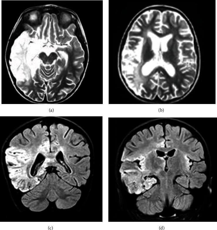 This diagnostic imaging panel consists of four brain MRI scans demonstrating findings associated with post-HSV-1 autoimmune encephalitis (NMDAR antibody-positive). The images include axial T2-weighted sequences (a, b) and coronal Fluid-Attenuated Inversion Recovery (FLAIR) sequences (c, d). All four views reveal prominent, confluent area of increased signal intensity (hyperintensity) localized to the right temporoparietal lobe. The pathology exhibits a corticosubcortical distribution, involving both the cerebral cortex and the underlying white matter. The T2 and FLAIR hyperintensities suggest significant vasogenic edema or inflammatory tissue changes within the affected region. These findings are characteristic of the neuroinflammatory processes seen in secondary autoimmune encephalitis following a viral trigger. The panel serves as a clinical example of how different MRI modalities can highlight localized inflammatory lesions in the temporal and parietal regions, essential for the diagnosis and management of complex neurological disorders.