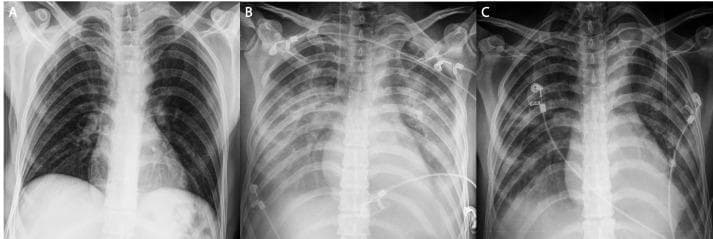 This composite of three anteroposterior (AP) chest x-rays illustrates the progression and resolution of Transfusion-Related Acute Lung Injury (TRALI). Image A represents a preoperative baseline showing clear lung fields, normal bronchovascular markings, and no medical devices. Image B demonstrates the acute phase of TRALI following blood transfusion, characterized by diffuse, bilateral pulmonary infiltrates and 'white-out' appearance consistent with non-cardiogenic pulmonary edema. Visible interventions in Image B include an endotracheal tube for mechanical ventilation, a right-sided central venous catheter, and ECG leads. Image C shows significant interval resolution of the bilateral infiltrates after several days of intensive care support. While the lungs have largely cleared, suggesting improved pulmonary compliance and gas exchange, the endotracheal tube has been removed (extubation), though central lines and monitoring electrodes remain. This sequence serves as a classic educational example of the rapid onset and potential for resolution of TRALI under appropriate ventilatory management.