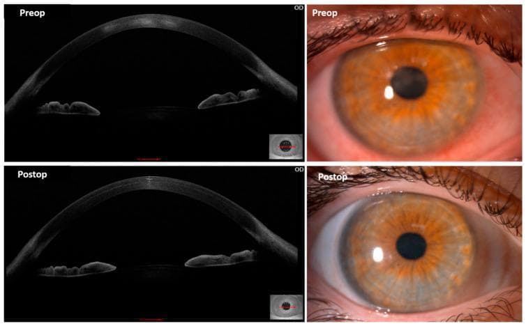 This composite figure displays comparative anterior segment optical coherence tomography (AS-OCT) and slit-lamp clinical photographs of an eye with advanced stage IV keratoconus, before (top row) and one month after (bottom row) autologous adipose-derived stem cell (ADSC) mid-stromal implantation. The pre-operative (Preop) slit-lamp image shows significant central corneal opacification and hazy scarring, while the corresponding OCT cross-section demonstrates irregular corneal thinning and high-reflectivity areas in the mid-stroma indicating scar tissue. The post-operative (Postop) images reveal a marked reduction in corneal haze and improved transparency in the slit-lamp photograph. The Postop AS-OCT scan shows a smoother corneal curvature and decreased density of the central stromal scars. Notably, the bottom-left OCT image highlights a localized area of increased stromal thickness and reflectivity at the site of the ADSC implantation, representing the successful production of new collagen and extracellular matrix (ECM) deposits. This comparison illustrates the potential for cellular therapy to promote stromal remodeling and restore optical clarity in diseased corneas.