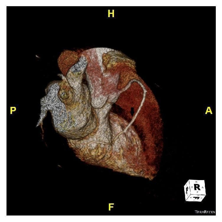 Diagnostic image showing a three-dimensional (3D) volume-rendered reconstruction of the heart from a Coronary Computed Tomography Angiogram (CCTA). The image presents an inferior-oblique perspective, with anatomical orientation markers for Anterior (A), Posterior (P), Head (H), and Foot (F). The primary finding is a super-dominant Right Coronary Artery (RCA), indicated by a black arrow, which exhibits a large caliber and extended course across the diaphragmatic surface of the heart. This vascular morphology is often associated with the congenital absence or hypoplasia of the left circumflex artery (LCX), where the RCA compensates by providing perfusion to the lateral and posterior territories of the left ventricle. The 3D rendering uses color-coded tissue density mapping to differentiate between myocardial surface, vascular structures, and the cardiac base. This visualization is clinically significant for evaluating coronary artery anomalies, vascular dominance patterns, and surgical or interventional planning in patients with exertional dyspnea or atypical chest pain.