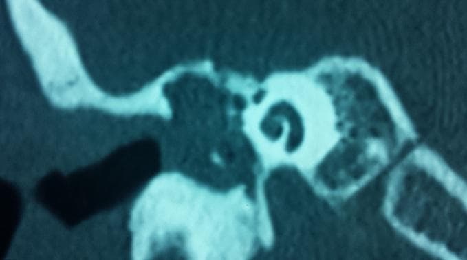 This diagnostic image is a coronal Computed Tomography (CT) scan of the temporal bone, specifically the middle ear and surrounding mastoid structures. The scan reveals a large, non-enhancing soft tissue density within the middle ear cavity and epitympanum, characteristic of a cholesteatoma. Key pathological findings include the significant erosion and partial lysis of the ossicular chain, involving the malleus and incus. There is also evident blunting and erosion of the scutum (the lateral wall of the attic), a classic radiographic sign of an acquired cholesteatoma. The bony labyrinth, including the cochlea and semicircular canals, appears relatively spared. The tegmen tympani remains intact without obvious intracranial extension. This image demonstrates the destructive nature of middle ear cholesteatoma on the conductive hearing apparatus and its impact on the local bony architecture of the temporal bone, serving as a primary tool for preoperative planning in otolaryngology.