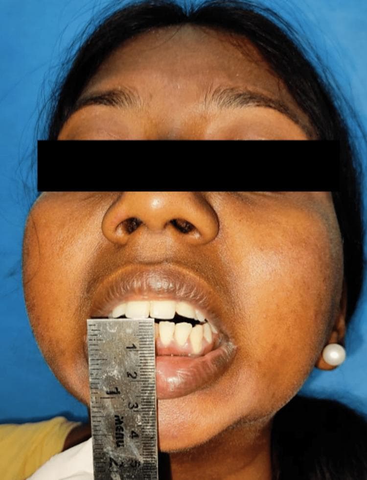 A frontal clinical photograph of a patient illustrating severe trismus (limited mouth opening) secondary to temporomandibular joint (TMJ) reankylosis. A metal ruler is used for objective clinical measurement, placed vertically between the maxillary and mandibular central incisors, demonstrating a near-zero interincisal distance. The image shows significant facial asymmetry with fullness in the lower third of the face and a characteristic retrognathic or 'bird-face' appearance common in chronic TMJ ankylosis. Visible intraoral features within the narrow aperture include the maxillary incisors and a portion of the mandibular teeth and gingiva. This procedural image captures the preoperative assessment of jaw mobility for a patient undergoing surgical intervention, such as an Esmarch osteotomy or gap arthroplasty, to restore functional mandibular range of motion.