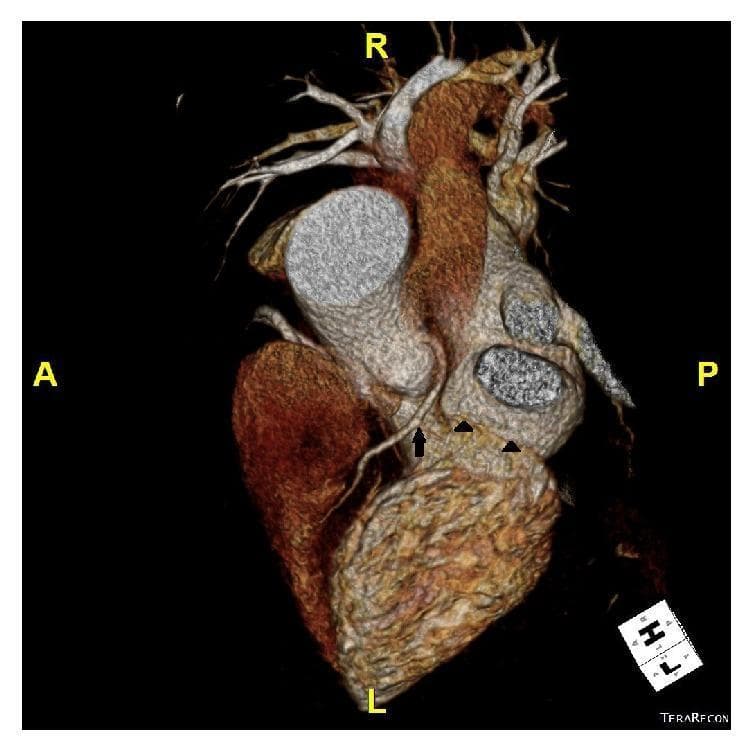 This diagnostic image is a three-dimensional volume-rendered computed tomography (CT) coronary angiogram of the human heart, presented from a superior (top) view. Anatomical orientation markers indicate Anterior (A), Posterior (P), Right (R), and Left (L) axes. The image highlights a rare congenital coronary artery anomaly: the isolated absence of the left circumflex artery (LCX). A single arrow points to the left anterior descending (LAD) artery, which originates and courses normally along the anterior interventricular groove toward the apex. Black arrowheads indicate the vacant atrioventricular groove where the LCX would typically reside. Other visible structures include the ascending aorta, positioned centrally and oriented toward the right, and the superior vena cava. This scan is educationally significant for demonstrating coronary anatomical variants that may mimic ischemic heart disease symptoms, such as exertional dyspnea, by altering typical myocardial perfusion patterns despite the absence of obstructive atherosclerotic lesions.