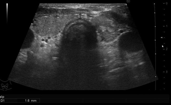 Diagnostic ultrasound image of the thyroid gland in a transverse plane, showing the right and left lobes connected by the isthmus overlying the trachea. The thyroid gland appears normal in size but exhibits a heterogeneous echotexture. Multiple small, predominantly hypoechoic nodules are visible within the parenchyma, particularly in the right lobe (left side of the image). These nodules vary in shape and possess relatively ill-defined to partially well-defined margins. Caliper measurements are visible at the isthmus, indicating a thickness of 1.6 mm. The surrounding structures, including the carotid arteries and internal jugular veins, appear as anechoic circular structures lateral to the thyroid lobes. This imaging demonstrates typical findings associated with a multinodular goiter or focal thyroiditis in the clinical context of hypothyroidism and positive thyroid antibodies. The educational focus is on identifying nodular pathology within the thyroid using ultrasonography.