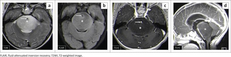 Diagnostic neuroimaging panel showing a diffuse intrinsic pontine glioma (DIPG). The panel includes axial T2-weighted (a), axial FLAIR (b), axial T1-weighted post-contrast (c), and sagittal T1-weighted post-contrast (d) MRI sequences. The images demonstrate a large, infiltrative mass (*) that significantly expands the pons. On T2WI and FLAIR, the lesion is homogeneously hyperintense relative to normal brain parenchyma. On T1-weighted post-contrast images, the mass appears hypointense and lacks significant gadolinium enhancement. A characteristic feature is the anterior displacement and encasement of the basilar artery (arrow), which remains patent, appearing as a signal void on non-contrast sequences and enhancing on post-contrast axial views. The sagittal view (d) highlights the craniocaudal extent of the pontine expansion and its mass effect on the fourth ventricle. This set illustrates the typical imaging hallmark of an aggressive pediatric brainstem glioma in the infratentorial compartment.