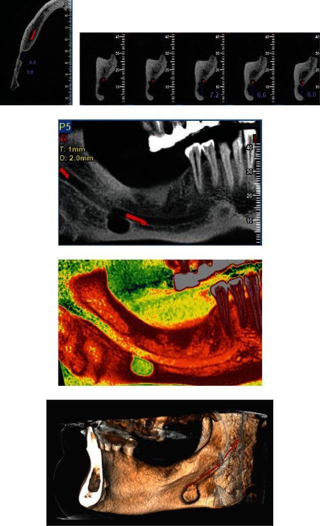 This composite diagnostic image features multiple Cone Beam Computed Tomography (CBCT) views of a Stafne bone cavity in the posterior mandible. (a) An axial cut identifies a well-defined lingual cortical defect measuring 9.8 x 4.8 mm in the right mandible. (b) Para-axial cross-sections demonstrate the monocystic nature of the cavity, showing its location on the lingual aspect of the mandible with a clear cortical margin situated approximately 7.2 mm below the mandibular canal. (c, d) Panoramic reconstructions, including one with color spectrum visualization, illustrate the ovoid, well-demarcated radiolucent lesion separated from the inferior alveolar nerve canal by a intact bone. (e) A 3D volumetric reconstruction provides a spatial overview of the defect, highlighting its relationship with the mandibular canal and the posterior mandibular anatomy. These views are characteristic of a submandibular gland depression, a developmental pseudocyst typically found incidentally below the mandibular canal in the molar-angle region.