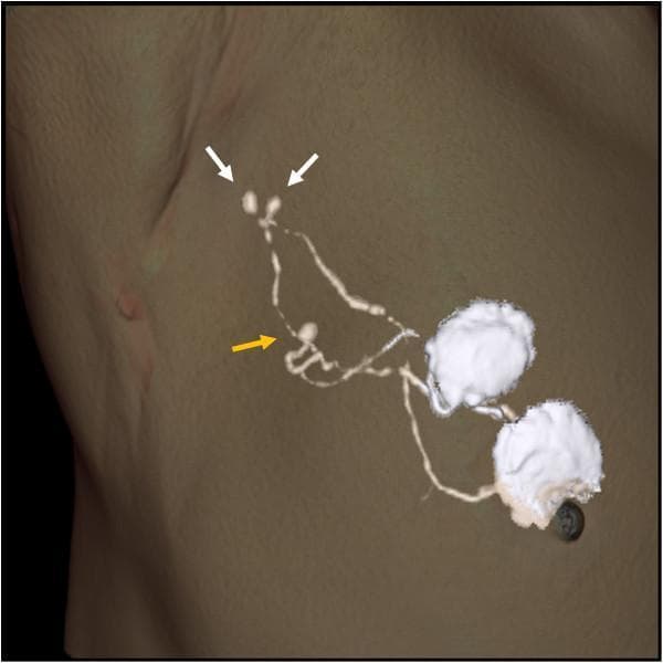 A three-dimensional (3D) volume-rendered CT lymphography image of the axillary region in a patient with breast cancer, demonstrating lymphatic drainage pathways and sentinel nodes. The image displays a skin-rendered surface with overlaid hyper-dense (white) structures representing contrast-enhanced lymphatic vessels and nodes. Two proximal sentinel lymph nodes are indicated by white arrows, appearing as small, ovoid, high-density structures connected by delicate, branching lymphatic channels. A third, more distal sentinel node is highlighted by a yellow arrow, located along a separate lymphatic tributary. The lymphatic flow originates from large, irregular high-density areas representing the intradermal contrast injection sites near the nipple-areolar complex. A metallic localizing marker is visible on the skin surface to facilitate surgical planning. This diagnostic imaging highlights the utility of CT lymphography in identifying multiple or widely distributed sentinel nodes that might be overlooked during conventional radioisotope or dye-only mapping due to spatial separation or signal interference from the primary injection site.