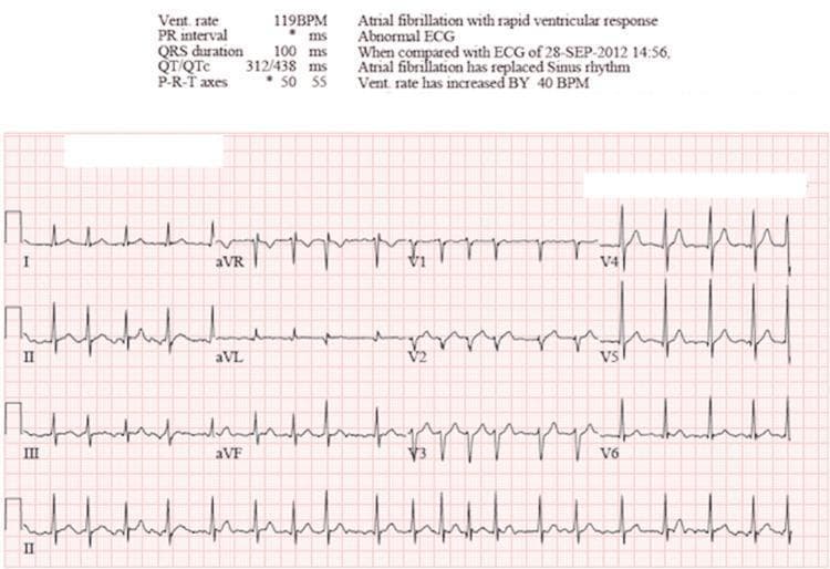 A standard 12-lead diagnostic electrocardiogram (ECG) demonstrating atrial fibrillation with rapid ventricular response (RVR). The tracing shows a classic irregularly irregular rhythm with narrow QRS complexes (100 ms duration). There is a total absence of discernible P waves, which are replaced by baseline fibrillatory oscillations, most visible in lead V1. The ventricular rate is approximately 119 beats per minute, indicating tachycardia. The ECG includes the limb leads (I, II, III, aVR, aVL, aVF) and precordial leads (V1-V6), with a continuous rhythm strip of lead II at the bottom. Automated measurements provided at the top of the tracing confirm a QTc of 438 ms and a heart rate increase compared to prior records. This diagnostic image serves as a clinical example of supraventricular tachycardia originating from disorganized atrial electrical activity, necessitating evaluation for hemodynamic stability and rate/rhythm control.
