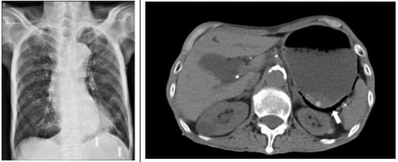This dual-panel diagnostic image displays a posterior-anterior (PA) chest radiograph on the left and a non-contrast axial abdominal CT scan on the right, illustrating features of gastric emphysema. The chest X-ray demonstrates interstitial opacities in the left lower lung zone and a prominent air bubble located beneath the left hemi-diaphragm, indicated by white arrows. The cardiac silhouette appears slightly enlarged, and the lung fields show hyperinflation consistent with COPD. The axial CT scan on the right highlights a markedly dilated stomach. A white arrow points to pneumatosis gastrica (intramural gas), visualized as linear streaks and small pockets of air within the posterior stomach wall. Calcifications of the abdominal aorta and spinal osteophytes are also visible. This combination of findings is characteristic of gastric emphysema, an uncommon condition where gas collects within the gastric wall, often associated with gastric outlet obstruction or mucosal injury. These visuals serve as a clinical example of using multi-modal imaging to identify gastric distention and associated mural air in acute abdominal presentations.