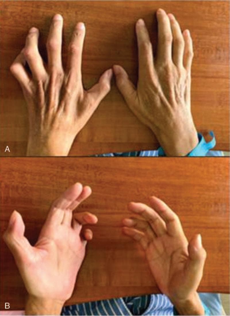 Clinical photograph of bilateral hands from a dorsal (A) and palmar (B) perspective, demonstrating characteristic features of ulnar nerve palsy. The primary visual finding is a 'claw hand' or 'benediction hand' deformity, most prominent on the left side, characterized by hyperextension at the metacarpophalangeal (MCP) joints and flexion at the proximal and distal interphalangeal (PIP and DIP) joints of the fourth and fifth digits. There is marked atrophy of the intrinsic hand muscles, specifically visible as hollowing of the interosseous spaces on the dorsal aspect and flattening of the hypothenar and thenar eminences on the palmar aspect. The skin appears thin with prominent tendons and vasculature, indicating loss of muscle bulk. This presentation is consistent with severe, chronic ulnar neuropathy, illustrating the loss of lumbrical and interossei muscle function. Educational concepts include the 'ulnar paradox' where distal lesions may appear more severe and the clinical manifestation of McGowan classification stages of nerve injury.