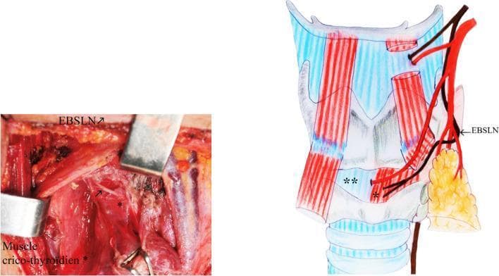This composite image illustrates the surgical anatomy of the thyroid region, specifically focusing on the anatomical variations of the external branch of the superior laryngeal nerve (EBSLN). On the left, a clinical photograph shows an intraoperative surgical field during thyroidectomy, with labels identifying the EBSLN and the cricothyroid muscle. Metallic retractors are used to provide exposure. On the right, a corresponding anatomical diagram depicts the Type IV Kierner classification. The diagram shows the EBSLN (labeled) descending and passing directly between the trifurcation branches of the superior thyroid artery (STA) just above the upper pole of the thyroid gland. The cricothyroid muscle is shown as the destination for the nerve fibers. This visual illustrates a critical surgical risk zone where the nerve is susceptible to injury during ligation of the superior thyroid pedicle. The educational focus is on identifying variations in nerve-vessel relationships to prevent postoperative vocal cord dysfunction in endocrine surgery.