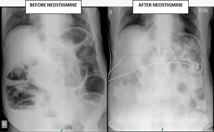 A comparison of two anteroposterior (AP) erect abdominal X-rays demonstrating the radiological management of acute colonic pseudo-obstruction (Ogilvie's syndrome). The 'Before Neostigmine' image shows marked gaseous distention of the large and small bowel loops throughout the abdominal cavity, with prominent multiple air-fluid levels indicative of functional bowel obstruction. The 'After Neostigmine' image shows a significant reduction in bowel loop caliber and a decrease in the number and height of air-fluid levels, indicating successful pharmacological decompression. In the second image, a radiopaque nasogastric (NG) tube is visible, coursing from the upper midline into the left upper quadrant, terminating in the stomach for decompression. Additional monitoring leads are visible on the periphery. This comparison illustrates the clinical effectiveness of neostigmine, an acetylcholinesterase inhibitor, in restoring bowel motility and reducing intraluminal pressure in cases of pseudo-obstruction.
