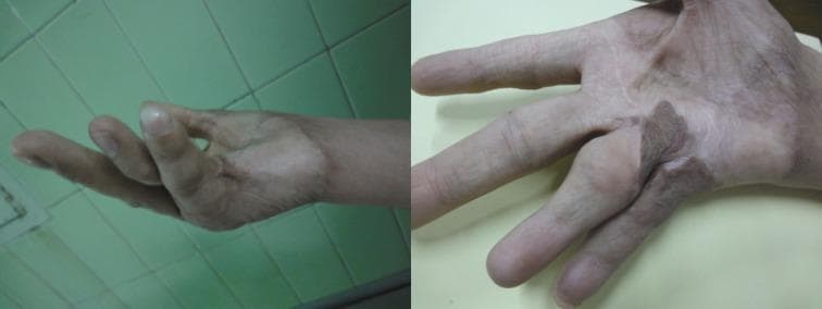Clinical photograph presenting two views of a human hand following surgical reconstruction for burn contracture. The images demonstrate the long-term appearance of full-thickness skin grafts (FTSG) applied to the fourth and fifth digits. On the fourth finger, the graft exhibits significant post-inflammatory hyperpigmentation, appearing as a dark brown, demarcated patch that contrasts sharply with the surrounding paler skin of the palm and digit. In comparison, the graft on the fifth finger shows less pigmentation. Visually, the fourth and fifth fingers are in a state of adduction and partial flexion, suggesting residual contracture and restricted range of motion. The skin in the interdigital space and proximal phalanges shows altered texture and scarring typical of post-burn sequelae. This educational material illustrates common postoperative outcomes in plastic and reconstructive surgery, specifically highlighting variations in graft pigmentation and the physical manifestation of digital burn contractures.