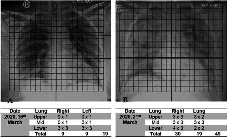 Comparison of serial chest radiographs demonstrating the progression of COVID-19 pneumonia over a five-day interval (March 16 to March 21, 2020). The images utilize a grid-based Radiologic Severity Index (RSI) assessment, dividing each lung into upper, middle, and lower zones. Image A (initial) shows bilateral basilar-predominant opacities, primarily in the lower zones, with an RSI score of 19. Image B (follow-up) reveals a significant increase in lung pathology, characterized by the development of diffuse ground-glass opacities and consolidation extending into the middle and upper zones bilaterally. This progression is quantified by a total RSI score increase to 49, with the right lung showing more severe involvement (30) than the left (19). The visual findings illustrate the rapid evolution of viral pneumonia, characterized by increased volumetric density and wider anatomical distribution of pulmonary lesions. This comparison serves as an educational tool for evaluating disease severity and progression in acute respiratory infections using standardized scoring systems.