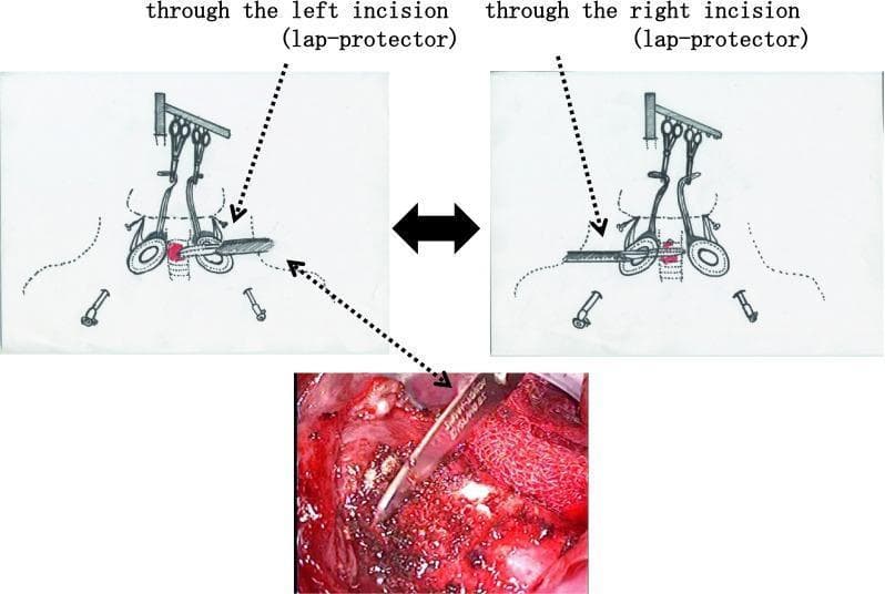 This composite educational resource illustrates the surgical 'shaving' technique for tracheal invasion during thyroid cancer surgery. The figure consists of two anatomical diagrams (top) and one intraoperative photograph (bottom). The diagrams depict a bilateral surgical approach using small supraclavicular incisions fitted with lap protectors. Visible instruments include retractors secured to a cradle and various clamps/ligating tools providing exposure to the tracheal cartilage. The bilateral view emphasizes that the invasive lesion can be accessed through either the left or right incision ports. The lower clinical photograph provides a close-up, intraoperative view of the procedure, showing a scalpel performing a tangential dissection (shaving) of tumor tissue from the tracheal wall while attempting to preserve the integrity of the airway. This technique is typically employed in thyroid surgery when complete resection is possible without necessitating a full tracheal resection and reconstruction.