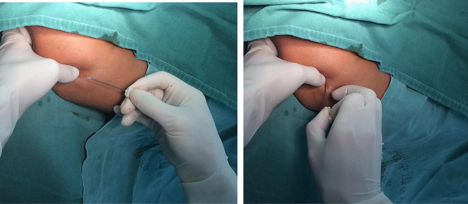 Clinical photograph of an acupotomy procedure for lateral epicondylitis (tennis elbow). The two-panel image demonstrates the surgical technique using a specialized, streamlined 0.6 mm diameter solid needle. The patient's arm is draped with green surgical drapes, exposing the lateral epicondyle region of the humerus. In the left panel, a clinician wearing white sterile gloves is shown preparing for insertion, with one hand stabilizing the soft tissue and the other holding the acupotomy needle. In the right panel, the needle is inserted into the tissue at a 90-degree angle, demonstrating the 'cutting and peeling' or 'transverse oscillation' technique directed toward the bone. This minimally invasive procedure is used to release tendinous tissue and adhesions to relieve pain and improve joint function. The image illustrates a key therapeutic intervention for chronic tendinopathy within an orthopedic or sports medicine context.