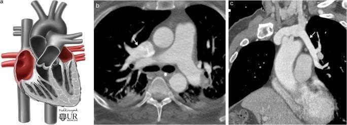 This composite educational material demonstrates Partial Anomalous Pulmonary Venous Return (PAPVR) through medical illustration and diagnostic imaging.
Panel A is a conceptual anatomical diagram of the heart and great vessels showing pulmonary veins draining aberrantly into the right atrium and superior vena cava (SVC), rather than the left atrium, creating a left-to-right shunt.
Panel B shows an axial contrast-enhanced CT image of an adult. A white arrow indicates an anomalous right upper lobe pulmonary vein draining directly into the SVC.
Panel C displays a double oblique contrast-enhanced CT reconstruction. The white arrow highlights an anomalous left upper lobe pulmonary vein (vertical vein) that drains superiorly into the left brachiocephalic vein.
The collection illustrates common variants of PAPVR, a congenital cardiovascular condition where some pulmonary veins drain into systemic venous circulation. These images are clinically significant for diagnosing incidental left-to-right shunts in adults, which may be asymptomatic or lead to right heart volume overload depending on the degree of anomalous flow.