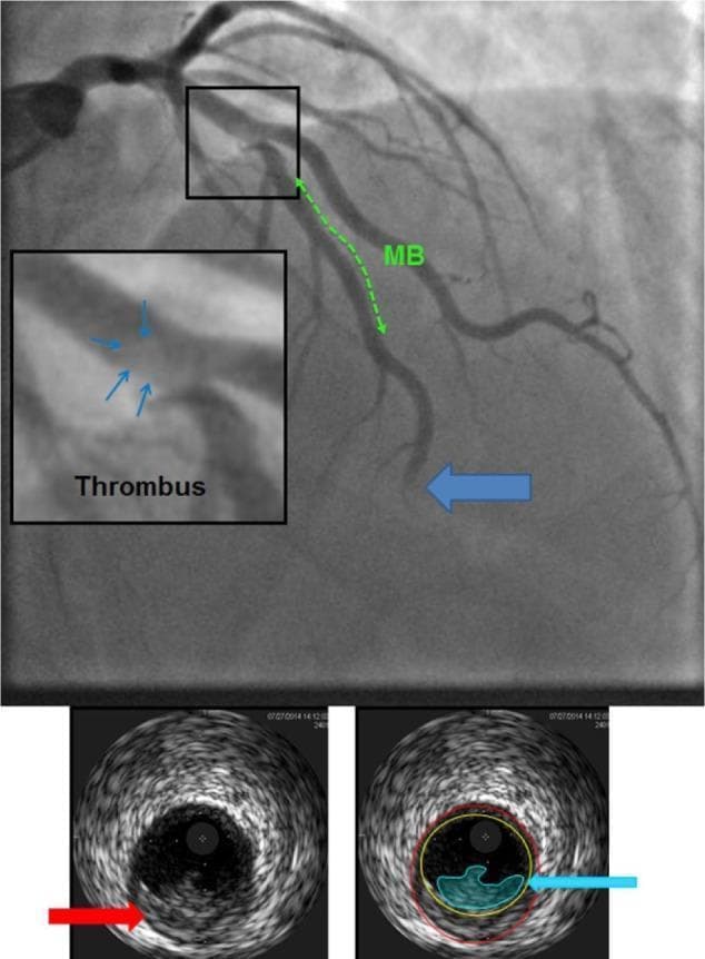 This composite clinical diagnostic image features a coronary angiogram and corresponding intravascular ultrasound (IVUS) frames depicting acute coronary syndrome. The large angiographic panel shows the Left Anterior Descending (LAD) artery. A proximal hazy filling defect, highlighted in a magnified inset, is consistent with an acute thrombus. A green dashed line identifies a myocardial bridge (MB) segment distal to the thrombus. A large blue arrow indicates a total distal occlusion of the LAD, suggestive of distal embolization from the proximal site. Below, two IVUS cross-sectional frames provide endovascular details. The left IVUS image uses a red arrow to denote a ruptured atherosclerotic plaque. The right IVUS image uses a blue arrow and light blue shading to highlight a luminal thrombus overlying the site of plaque rupture. This visual sequence demonstrates the pathophysiology of plaque rupture leading to local thrombus formation and subsequent distal coronary embolization in the setting of a myocardial bridge.