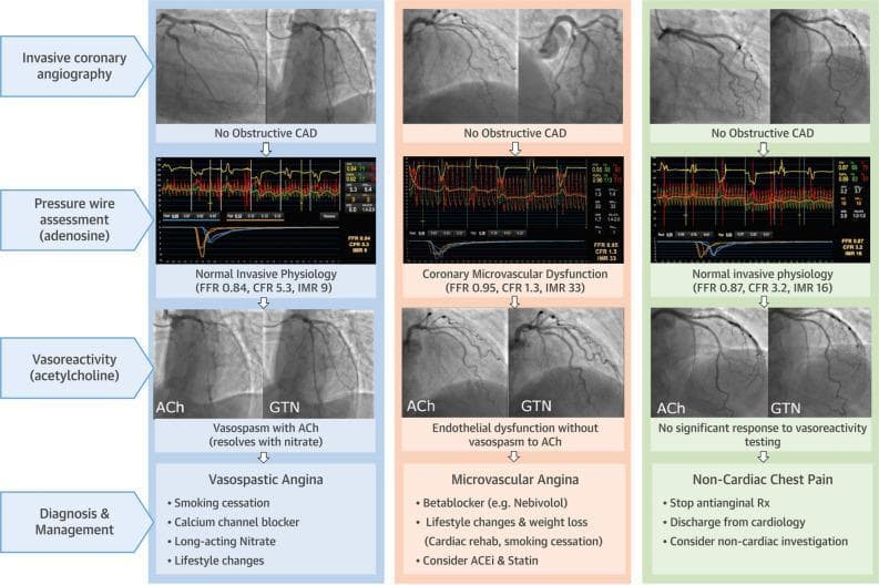 A multi-panel clinical infographic and flowchart illustrating the diagnostic pathway for Ischemia with Non-Obstructive Coronary Arteries (INOCA) through an Interventional Diagnostic Procedure (IDP). The graphic is organized into three vertical columns representing distinct clinical phenotypes: Vasospastic Angina, Microvascular Angina, and Non-Cardiac Chest Pain. Each column follows four sequential stages: (1) Invasive coronary angiography showing no obstructive coronary artery disease (CAD); (2) Pressure wire assessment with adenosine measuring physiological indices (FFR, CFR, and IMR); (3) Vasoreactivity testing with Acetylcholine (ACh) and Glyceryl Trinitrate (GTN); and (4) Final diagnosis and management strategies. The first column demonstrates Vasospastic Angina, characterized by ACh-induced vasospasm that resolves with GTN. The second column shows Microvascular Angina, defined by abnormal microvascular indices (low CFR, high IMR) and endothelial dysfunction without epicardial spasm. The third column depicts Non-Cardiac Chest Pain, where both physiology and vasoreactivity testing are normal. The diagram provides management recommendations for each phenotype, including calcium channel blockers for vasospasm and beta-blockers or lifestyle changes for microvascular dysfunction.