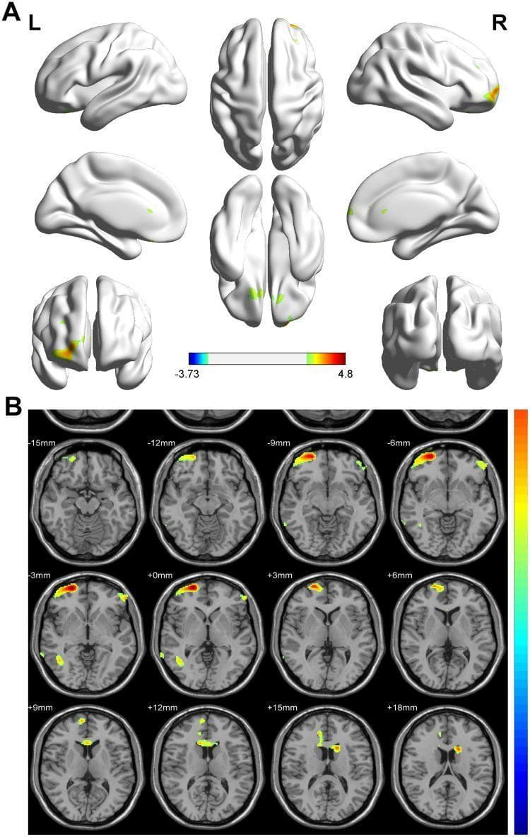 This diagnostic image displays a Voxel-Based Morphometry (VBM) comparison of regional gray matter volumes in infants. Panel A presents a 3D cortical surface mapping (brain render) from multiple orientations, including lateral, medial, superior, and inferior views. Yellow and red highlights indicate clusters of significantly higher gray matter volume in breastmilk-fed versus formula-fed infants, primarily localized to the bilateral frontal lobes, right temporal lobe, and focal areas of the occipital cortex. Panel B provides a complementary 2D visualization using a series of axial brain slices ranging from -15mm to +18mm in MNI space, following radiologic convention. These slices demonstrate significant volume differences in the prefrontal cortex (Brodmann areas 11 and 46), as well as subcortical involvement in the left caudate nucleus/basal ganglia region. A color-coded statistical scale represents T-values, with warmer colors indicating higher statistical significance. This neuroimaging study illustrates the impact of early nutrition on neonatal structural brain development and neuroanatomy.