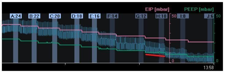 This diagnostic image displays a waveform graph from a decremental Positive End-Expiratory Pressure (PEEP) trial, used in critical care and respiratory medicine to optimize mechanical ventilation. The visualization monitors three primary variables over time, marked from segments A to J: end-inspiratory pressure (EIP, pink line), end-expiratory lung impedance (EELI, green line), and global lung impedance change (blue oscillating waveform). The x-axis represents a stepwise reduction in PEEP from 24 mbar (A) down to 6 mbar (J). A corresponding stepwise decrease is visible in the EIP and EELI, reflecting changes in lung volume. At a PEEP of 10 mbar (H), a red trend line highlights a gradual decline in the EELI waveform, indicating alveolar derecruitment despite constant pressure. This comparison chart is a key tool in Electrical Impedance Tomography (EIT) for identifying the 'best PEEP'—the level that maintains lung recruitment while avoiding overdistension. The educational focus is on identifying the point of lung collapse during ventilator weaning or ARDS management.