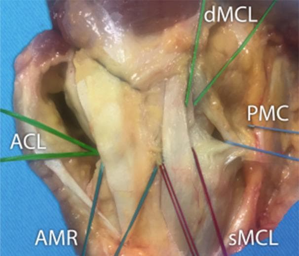 A clinical photograph of a cadaveric dissection showing the medial aspect of a right knee, focusing on the stabilizing ligamentous and capsular structures. The visual is divided into three functional zones. The middle third highlights the medial collateral ligament (MCL), clearly differentiated into its superficial layer (sMCL) and deep layer (dMCL). The superficial MCL is shown as a distinct longitudinal band, while the deep MCL appears closely associated with the joint capsule. The anterior third demonstrates the anteromedial retinaculum (AMR), which comprises the fascia and capsule. The posterior third shows the posterior medial capsule (PMC), where the deep layers merge into a thicker capsular complex that includes the posterior oblique ligament. Internally, the anterior cruciate ligament (ACL) is identified within the joint space. The image illustrates the complex layered anatomy of the medial knee, useful for understanding orthopedic surgical approaches and biomechanical stability. The structures are marked with color-coded lines and anatomical abbreviations for educational clarity.