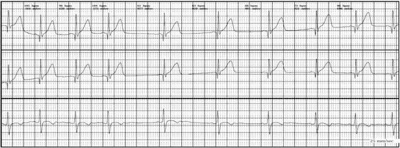 This diagnostic image displays a three-channel surface electrocardiogram (ECG) rhythm strip illustrating respiratory sinus arrhythmia (RSA). The tracing is set against a standard millimeter grid background with a recorded paper speed of 25 mm/sec. The top two panels demonstrate synchronized lead recordings featuring distinct P-waves, narrow QRS complexes, and prominent T-waves. Key visual features include significant variation in the R-R intervals, which correspond to phasic changes in heart rate. Annotation text at the top of the tracing indicates fluctuating heart rates ranging from approximately 61 bpm to 104 bpm. The morphology of the individual complexes remains consistent, indicating the rhythm originates from the sinoatrial node, but the cyclic lengthening and shortening of the heart rate are characteristic of respiratory-induced autonomic modulation. This ECG is a classic representation used in clinical cardiology and pediatrics to distinguish benign sinus arrhythmia from more concerning dysrhythmias, such as those occurring during breath-holding spells.