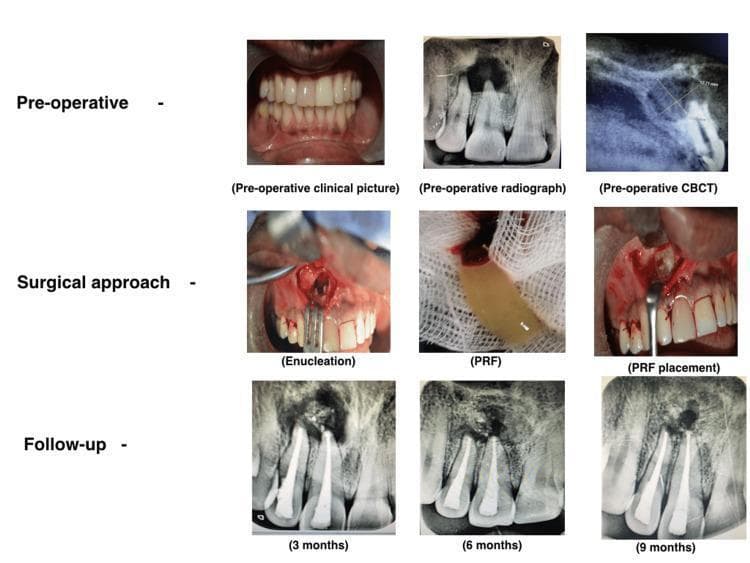A multi-panel medical compilation illustrating the management of a periapical lesion (radicular cyst) associated with the maxillary right central incisor (tooth 11). The content is organized into three rows: Pre-operative, Surgical approach, and Follow-up. The pre-operative row includes a clinical photograph showing tooth discoloration, a periapical radiograph with a large radiolucency, and a sagittal CBCT view measuring the lesion's labio-palatal extent. The surgical approach row shows the intraoperative enucleation of the cyst, the preparation of yellowish Platelet-Rich Fibrin (PRF), and its subsequent placement into the surgical cavity. The follow-up row consists of three serial periapical radiographs at 3, 6, and 9 months, demonstrating progressive healing. These radiographs show the tooth with a radio-opaque retrograde filling material (MTA) and a gradual decrease in the periapical radiolucent area, replaced by increasing radiopacity indicative of successful bone regeneration and ossification.