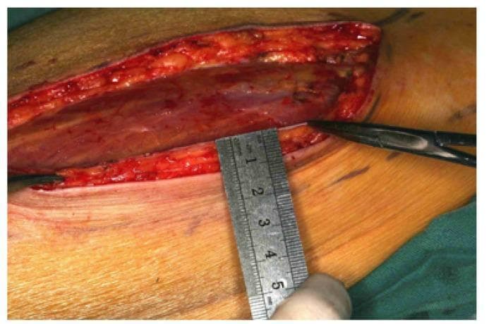 This clinical photograph shows an intraoperative view of an anterolateral thigh (ALT) flap during harvest for reconstructive surgery. An elongated surgical incision is visible along the medial margin of the flap, extending down to the deep fascia. Within the wound bed, the striated texture of the underlying muscle and adipose tissue is evident. A metallic surgical ruler is held perpendicularly against the elevated skin flap to measure its vertical thickness. The ruler shows that the flap currently measures approximately 10 mm in thickness before the thinning process. Surgical instruments, including a pair of forceps, are positioned within the field to assist in tissue retraction and dissection. The image illustrates the anatomical layers of a typical fasciocutaneous flap and demonstrates the clinical technique of verifying flap thickness prior to microvascular transplantation. This material is intended for surgical education, specifically focusing on the harvest of thin ALT flaps for procedures such as tongue reconstruction following hemiglossectomy.