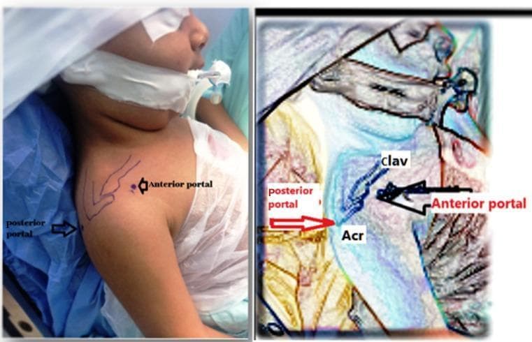 This clinical photograph and annotated anatomical diagram demonstrate preoperative surgical landmarks and portal planning for shoulder arthroscopy in a pediatric patient. The left image shows the patient in a supine beach chair position with surgical skin markings over the right shoulder. Key landmarks include the clavicle (clav) and the acromion (Acr), which are outlined to guide portal placement. The posterior portal is marked at the posterolateral corner of the acromion, providing the primary viewing entry point to the glenohumeral joint. The anterior portal is marked anteriorly, positioned to allow surgical access to the rotator interval, subscapularis tendon, and anterior capsule. The right image is a stylized, high-contrast overlay that emphasizes these osseous landmarks and the spatial relationship between the two portals, illustrating the triangulation technique required for arthroscopic visualization and instrumentation. This educational material is relevant for orthopedic surgical training, specifically for procedures involving glenohumeral joint contracture release or obstetric brachial plexus palsy sequelae.