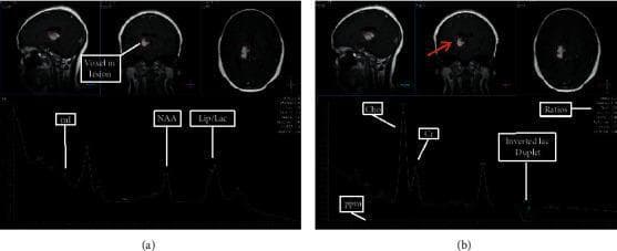 Educational composite featuring brain MRI and Proton Magnetic Resonance Spectroscopy (1H-MRS) used to evaluate high-grade glioma. The top panels show sagittal, coronal, and axial MR views with a single voxel localized precisely within a hyperintense intracranial lesion. The bottom panels present two spectral plots at different echo times (TE): (a) Short TE (31 msec) and (b) Intermediate TE (144 msec). The short TE spectrum highlights peaks for myo-inositol (mI), N-acetylaspartate (NAA), and a combined lipid/lactate (Lip/Lac) peak. The intermediate TE spectrum demonstrates characteristically elevated Choline (Cho) relative to Creatine (Cr) and an inverted lactate doublet at 1.3 ppm, confirming the presence of lactate. Key metabolic findings indicative of high-grade malignancy include a marked elevation in Cho (Cho:Cr ratio 2.93), significant reduction in NAA and myo-inositol, and elevated lipid and lactate levels. This comparison illustrates the diagnostic utility of varying echo times to resolve specific metabolites and assess tumor grade.