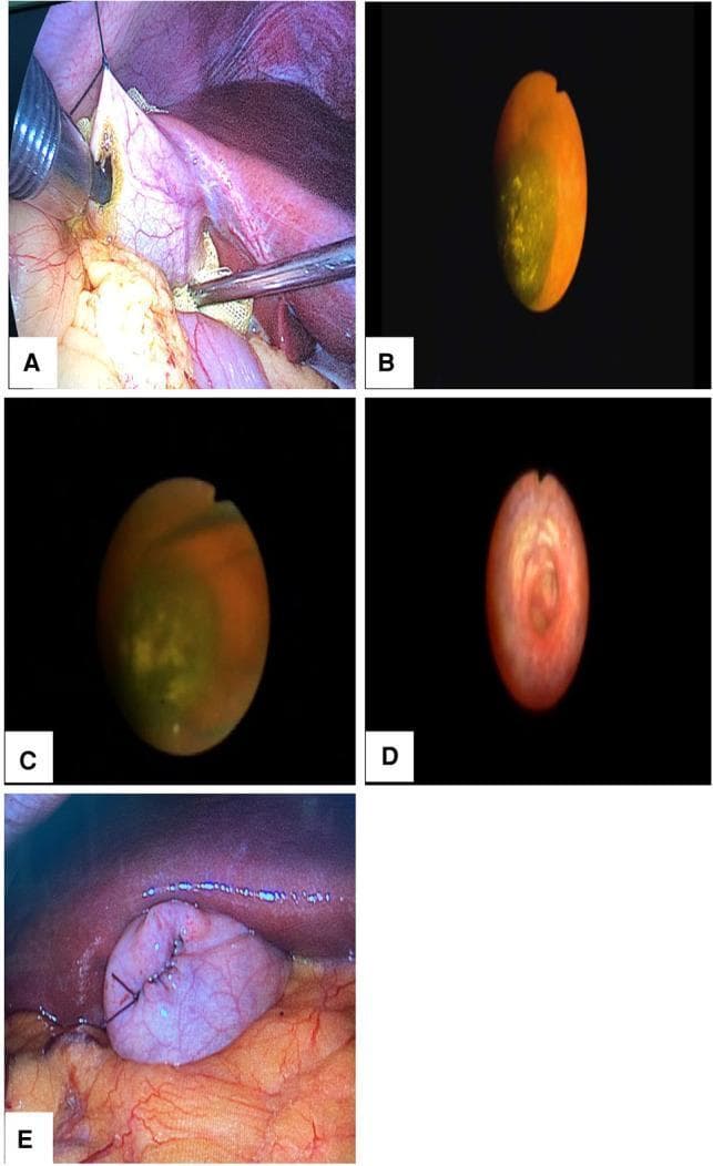 This composite intraoperative clinical photograph and endoscopic series documents the steps of minimally invasive gallbladder-preserving surgery (GPS) for cholecystolithiasis. Panel A (Laparoscopic view) shows the fundus of the gallbladder suspended from the abdominal wall with a 12-mm trocar inserted into the lumen. Panels B and C (Choledochoscopic views) visualize incarcerated yellowish-brown gallstones within the gallbladder neck, with a stone extraction basket engaged in Panel C. Panel D demonstrates the internal anatomy of the cystic duct, highlighting the spiral valves (valves of Heister) to confirm patency and complete stone clearance. Panel E (Laparoscopic view) illustrates the final procedural stage where the gallbladder incision is closed using a continuous suture technique with 4/0 absorbable material. The series highlights surgical techniques for organ preservation in symptomatic gallstone disease, focusing on direct endoscopic visualization for stone retrieval and anatomical verification of the biliary tract.